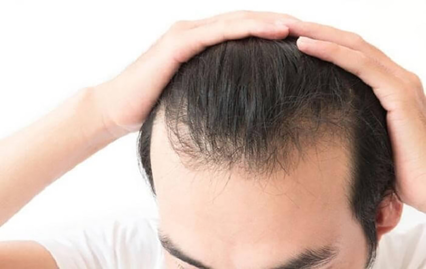 Rụng tóc hói đầu là một trong những biểu hiện của suy giảm nội tiết nam 